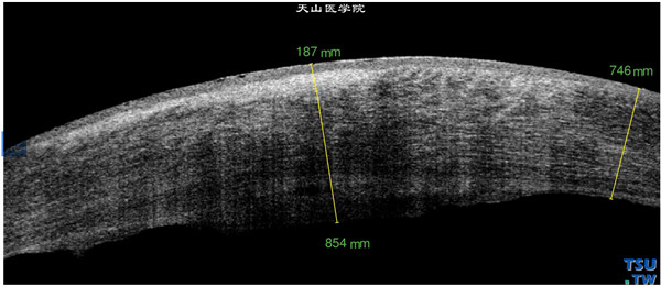 同一患者，RTvue OCT检查，可见角膜基质炎性水肿，增厚，表现为影像密度不均，有上皮细小水泡和病变区内皮层结构消失