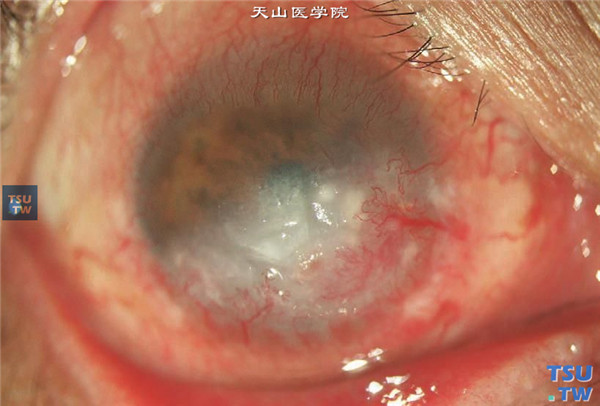 症状：单纯疱疹病毒性角膜炎深基质型表现为角膜基质坏死（基质坏死型），角膜基质内炎性反应明显，角膜水肿，深层大量新生血管长入