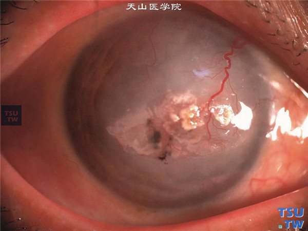 症状：单纯疱疹病毒性角膜炎基质坏死型，角膜基质有结瘢和炎性浸润共存，新生血管长入，角膜上皮下有类脂质样物质沉积