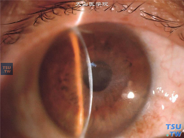 症状：同一患者，裂隙灯显微镜检查，可见角膜病变区内皮有皱褶，角膜水肿增厚