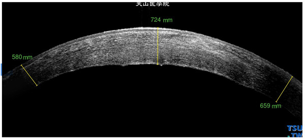 同一患者，RTvue OCT检查，可见角膜基质水肿、混浊、增厚，同时表现为病变区角膜内皮的损害