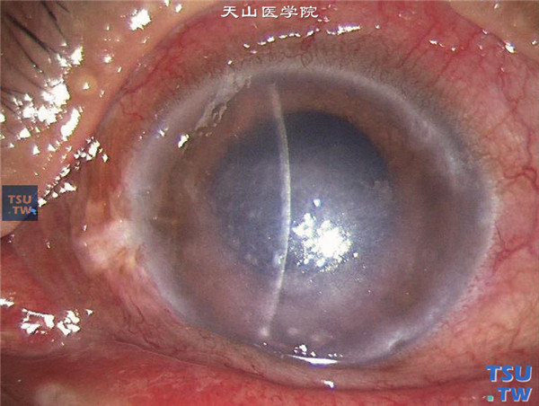 症状：单纯疱疹病毒性角膜炎内皮型