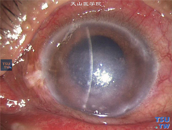 梅毒性髄膜炎とは何ですか?