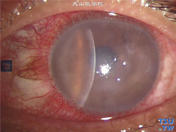 症状：上述四张图片显示单纯疱疹病毒性角膜炎内皮型，结膜混合充血，角膜炎症明显，基质弥漫性水肿，角膜内皮面可见大量羊脂状KP