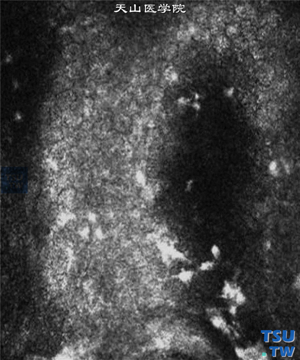 单纯疱疹病毒性角膜炎内皮型，临床共聚焦显微镜检查，可见角膜内皮细胞水肿，边界不清，大小不均，密度严重下降 ×1000