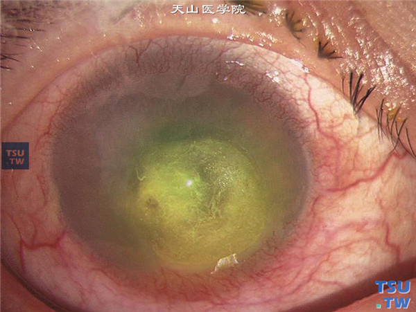 症状：单纯疱疹病毒性角膜炎合并细菌感染