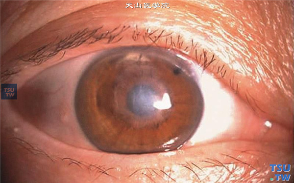 症状：单纯疱疹病毒性角膜炎基质型，稳定期，患者有十余年复发病史，角膜中央区有斑翳，视力0.04