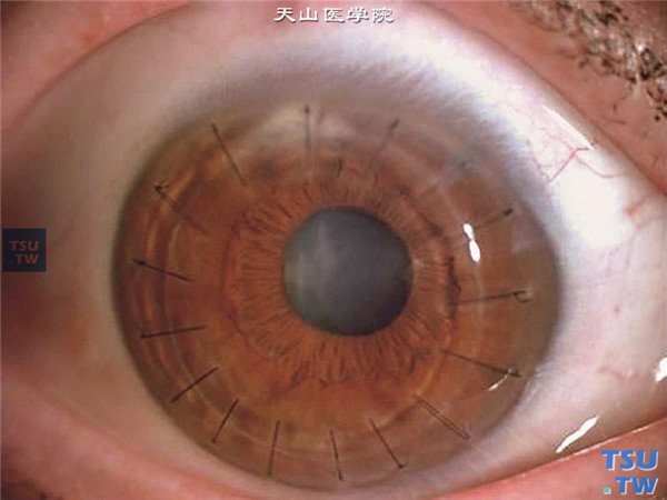 同一患者，行板层角膜移植术，术后随访18个月，角膜植片透明，无复发，视力0.4
