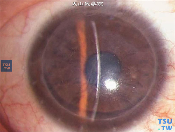 同一患者，行板层角膜移植术，术后随访2年，角膜植片透明，无复发，视力0.3