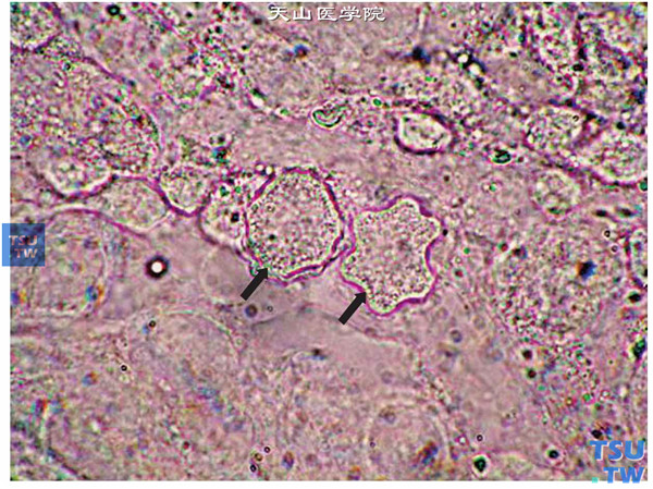 角膜病灶刮片采集标本，生理盐水湿片法，显微镜下观察到棘阿米巴包囊和（或）滋养体×1000