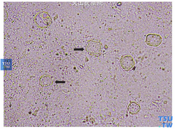 角膜病灶刮片采集标本，生理盐水湿片法，显微镜下观察到棘阿米巴包囊和（或）滋养体 ×400