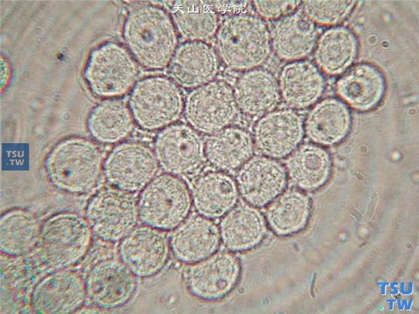 角膜病灶刮片，标本行病原微生物培养，可见棘阿米巴包囊 ×1000