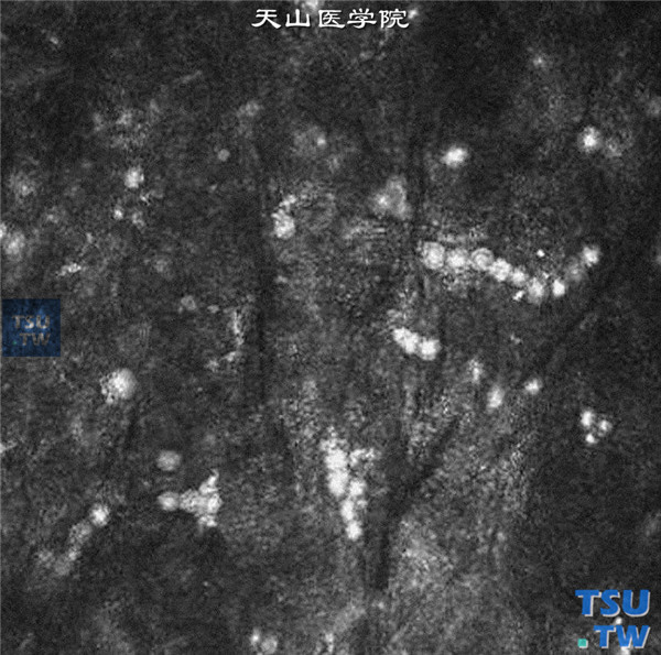 上述两张图片显示，对棘阿米巴角膜炎患者，行临床共聚焦显微镜检查，在角膜基质层，查见棘阿米巴包囊，影像呈圆形高密度外观 ×800