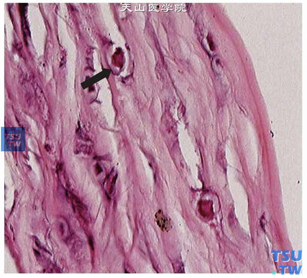 上述两张图片显示棘阿米巴角膜炎患者，术中获取病变角膜片行组织病理学检查，HE染色可见棘阿米巴包囊，HE染色 ×400