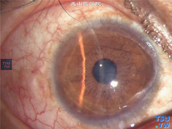 症状：同一患者，行大植片深板层角膜移植术，术后随访1年，角膜植片透明，病情稳定，无复发，视力0.6