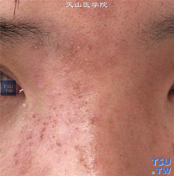 症状：带状疱疹病毒造成眼睑鼻根部皮肤永久性瘢痕，沿面部三叉神经分布