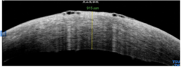 图3C. 同一患者，RTvue OCT检查，可见角膜基质水肿、增厚，角膜上皮下水泡，角膜内皮面粗糙，界面欠平整