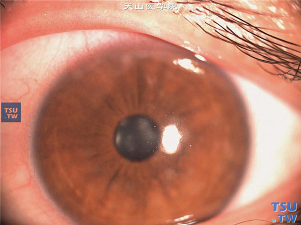 症状：流行性角结膜炎，角膜浅基质层钱币状炎性浸润（钱币状角膜炎），伴有睫状充血