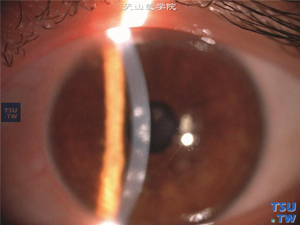 症状：流行性角结膜炎，同一患者，裂隙灯显微镜检查，可见角膜浅基质层有圆形炎性浸润