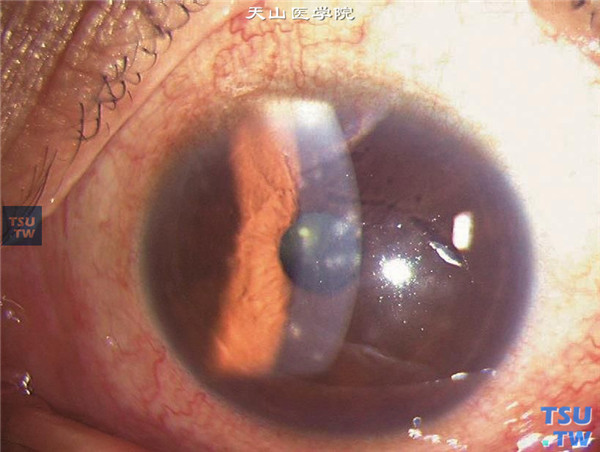  症状：流行性角结膜炎，同一患者，裂隙灯显微镜检查，可见角膜浅基质层钱币状炎性浸润