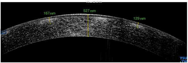 同一患者，RTvue OCT 检查，可见病变位于角膜浅基质层内，呈多个孤立的高密度影像，角膜上皮层和内皮层完整