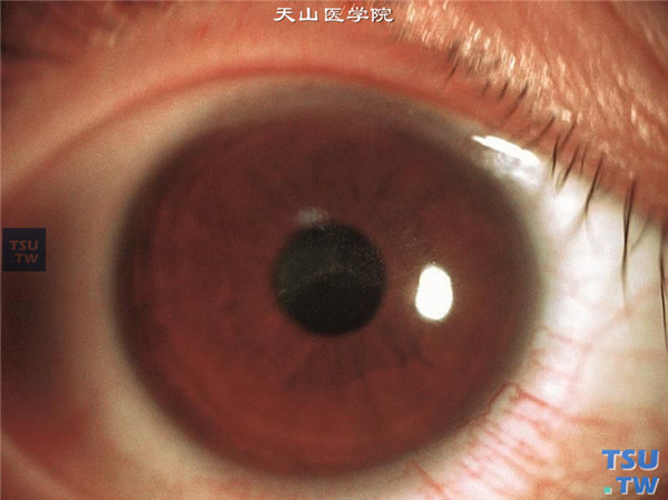 Thygeson浅层点状角膜炎，可见睫状充血，角膜上皮散在细小颗粒状浸润，角膜上皮粗糙