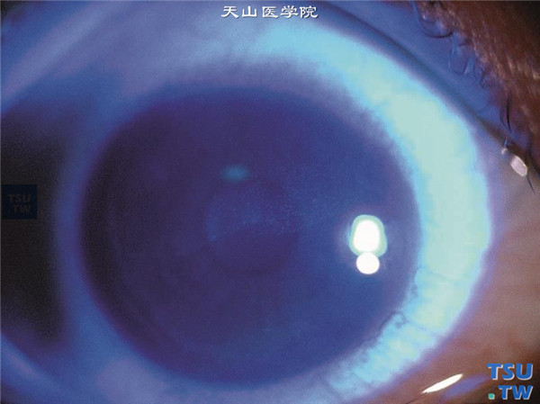 Thygeson浅层点状角膜炎，上图同一患者，可见角膜上皮细点状浸润，遍布角膜瞳孔区和角膜下方，荧光素钠染色阳性