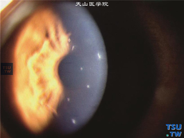 Thygeson浅层点状角膜炎，上图同一患者，裂隙灯显微镜宽裂隙光束照明检查，可见散在的病灶呈轻度点状隆起，位于角膜中央区