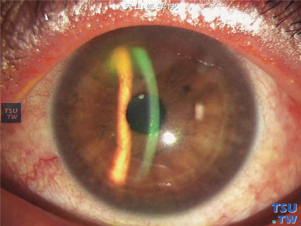 Thygeson浅层点状角膜炎，可见角膜上皮点、片状浸润，荧光素钠染色阳性，病变位于角膜中央区