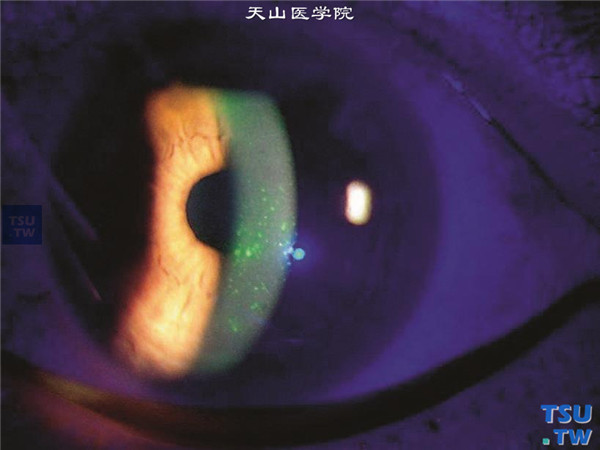 Thygeson浅层点状角膜炎，上图同一患者，裂隙灯宽裂隙光束照明检查，可见角膜中央区上皮点状浸润