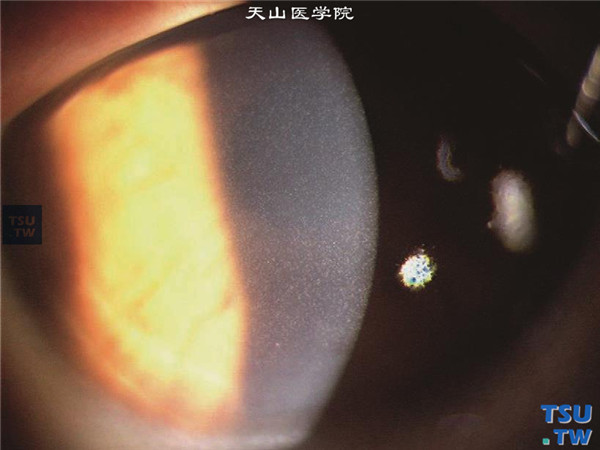 Thygeson浅层点状角膜炎，上图同一患者，裂隙灯宽裂隙光束照明检查，可见集合呈簇状的浸润病灶，角膜上皮弥漫性损害，但不连成片状