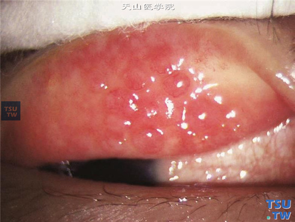 眼睑结膜炎症状图片图片