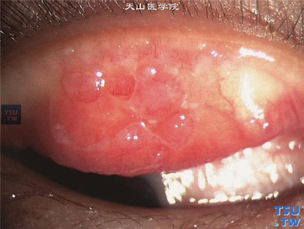 春季角结膜炎，睑结膜型，随着病情的进展，滤泡和乳头明显增大，满布在睑结膜面上，淡红色充血