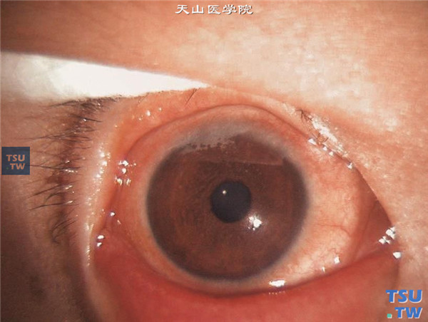 春季角结膜炎，角膜缘型，可见结膜充血，上方角巩膜缘红色胶样增生，此增生可发生在任何象限，但以上方角巩膜缘多见