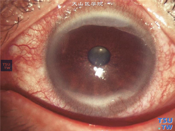 春季角结膜炎，角膜缘型，随着病情的发展，角膜缘出现血管翳，从角膜缘向角膜中央伸展，角膜周边出现环形浸润，呈灰白色外观