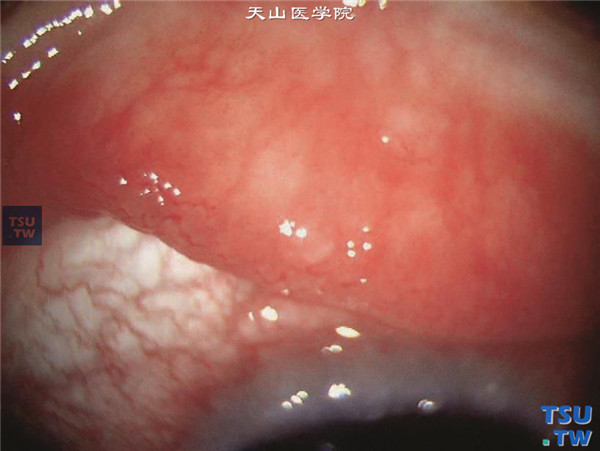 春季角结膜炎，混合型，结膜充血，睑结膜有小的铺路石样结膜滤泡