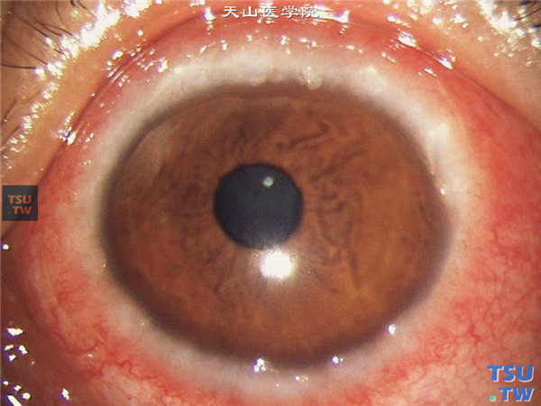 春季角结膜炎，上图同一患者，可见角膜缘以变性的嗜酸性粒细胞为中心的白色Frantas增生结节