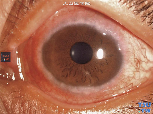 春季角结膜炎，混合型上图同一患者，可见角膜缘环形红色胶样增生，结膜充血，刺痒症状明显
