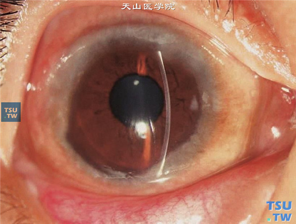 春季角结膜炎，角膜缘型，可见角膜缘环形白色Frantas增生结节