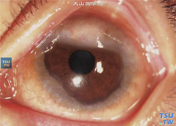 春季角结膜炎，角膜缘型上图同一患者左眼，可见角膜缘环形白色Frantas增生结节，上方高出角巩膜缘的胶样增生结节