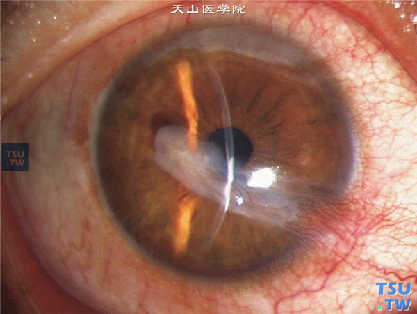 上述四张图片均为泡性角膜炎，可见病灶呈束状从角膜缘伸展到角膜中央，角膜病损处都有一束血管伴行，是泡性角膜炎的一种，称为束状角膜炎