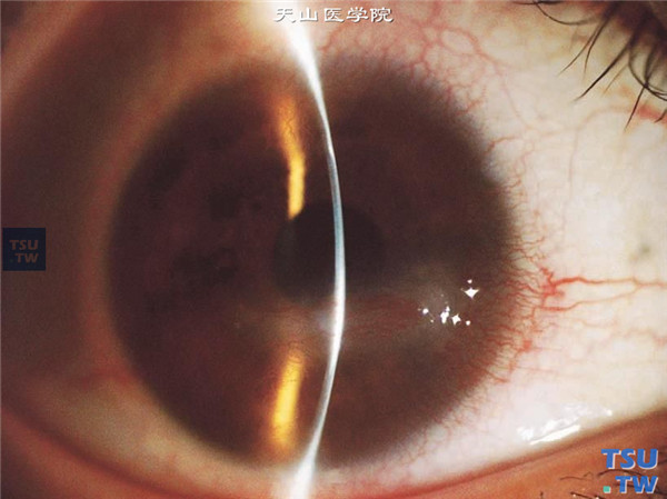 同一患者，裂隙灯显微镜检查，可见病变区角膜水肿混浊，角膜厚薄不均