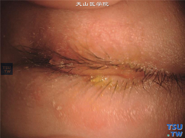 溃疡性睑缘炎合并泡性角膜炎，患者上下睑缘和睫毛根部有溃疡和脓性分泌物附着，眼睑皮肤有湿疹样改变