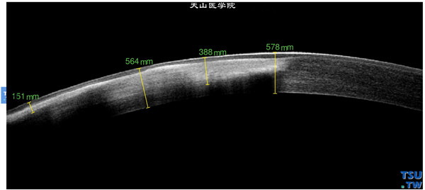 泡性角膜炎，上图同一患者，RTvue OCT检查，显示角膜基质层密度不均的影像，角膜上皮层完整