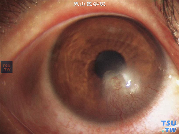 泡性角膜炎，反复发作，角膜基质炎性混浊，与角膜缘相连，伴有密集的新生血管