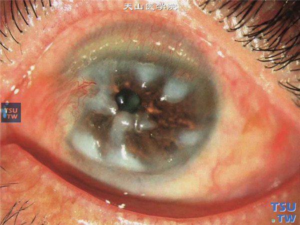 上述两张图片为同一患者，双眼泡性角膜炎反复发作，角膜多处瘢痕，伴有新生血管和假性胬肉