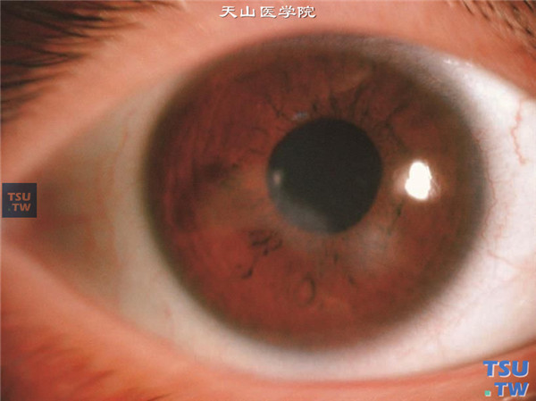 泡性角膜炎，上图同一患者，继续治疗4周，炎症消退，眼压正常，角膜仅留有云翳