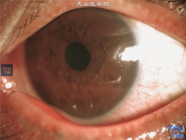 丝状角膜炎，上述两张图片显示丝状角膜炎，结膜轻度充血，角膜表面有丝状物附着