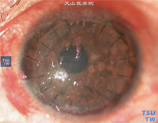 丝状角膜炎，穿透角膜移植术后发生丝状角膜炎，丝状物挂满角膜，虎红染色阳性