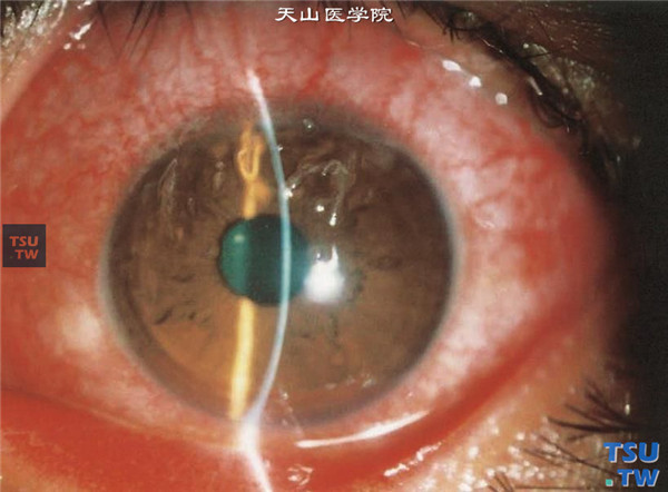 丝状角膜炎，干眼症患者发生丝状角膜炎，结膜充血，丝状物挂在角膜表面，以角膜上方多见，丝状物在角膜表面不易被擦去，需在手术显微镜下，用镊子夹取